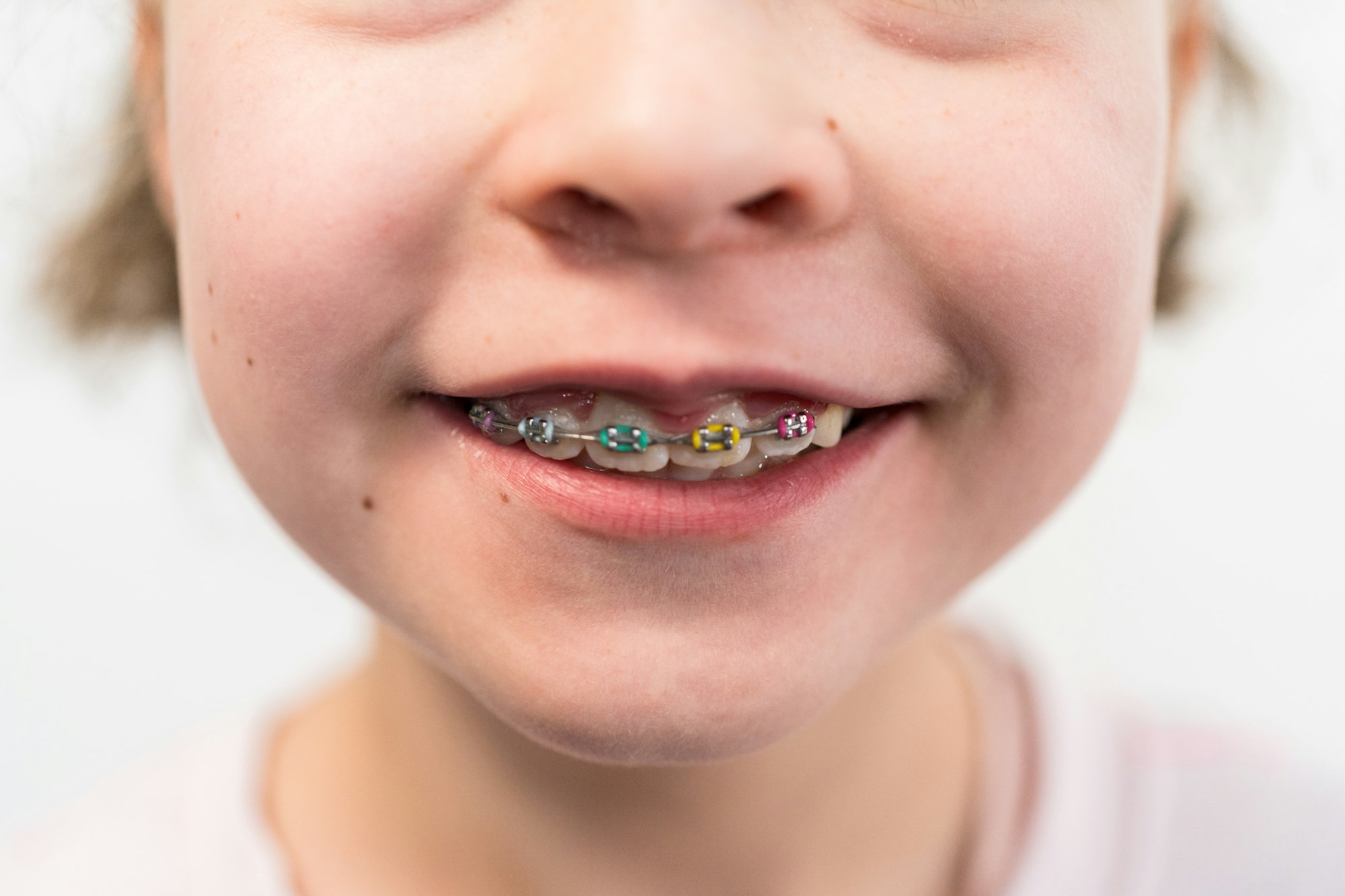 Little girl with rainbow braces